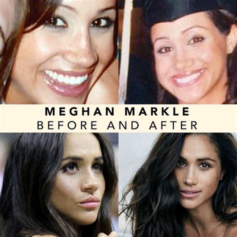 meghan markle nose job|The New Most Requested Nose Job: Meghan Markle